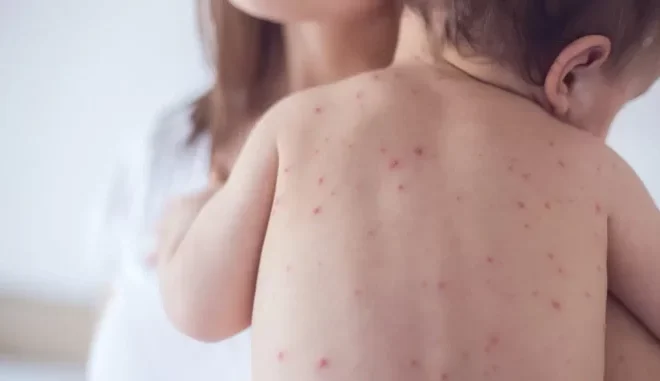 Caso suspeito de sarampo em 2026 é investigado no Ceará, que intensifica vigilância epidemiológica.